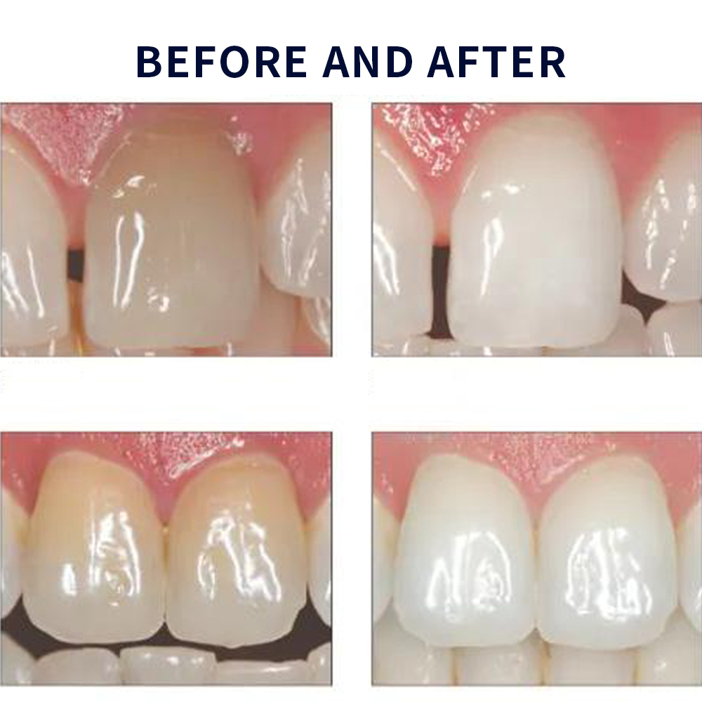 Opalescentie Whitening 20% Pf  - Teeth Whitening At Home Kit recensie en prijs