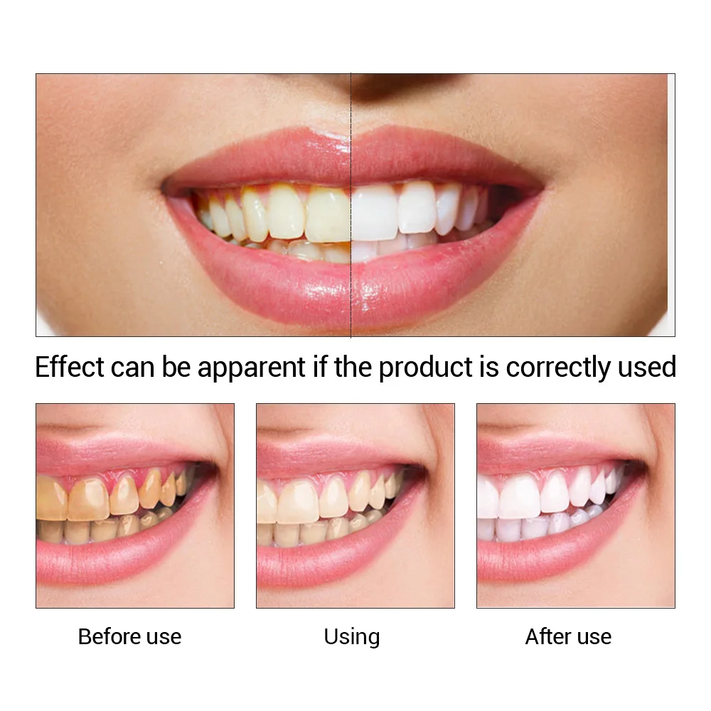 Fteenply Tanden Whitening Esse - Teeth Whitening/Bleaching recensie en prijs