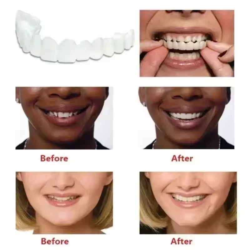 Tanden Veneers Bleekmiddelen P - Teeth Whitening Session recensie en prijs