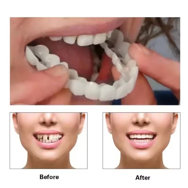 Tanden Veneers Bleekmiddelen P - Teeth Whitening Session recensie en prijs