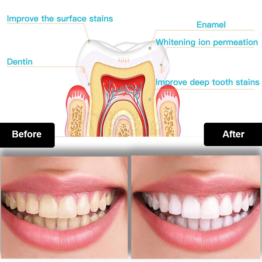 Tandheelkundige Tanden Whiteni - Teeth Whitening Remedies recensie en prijs